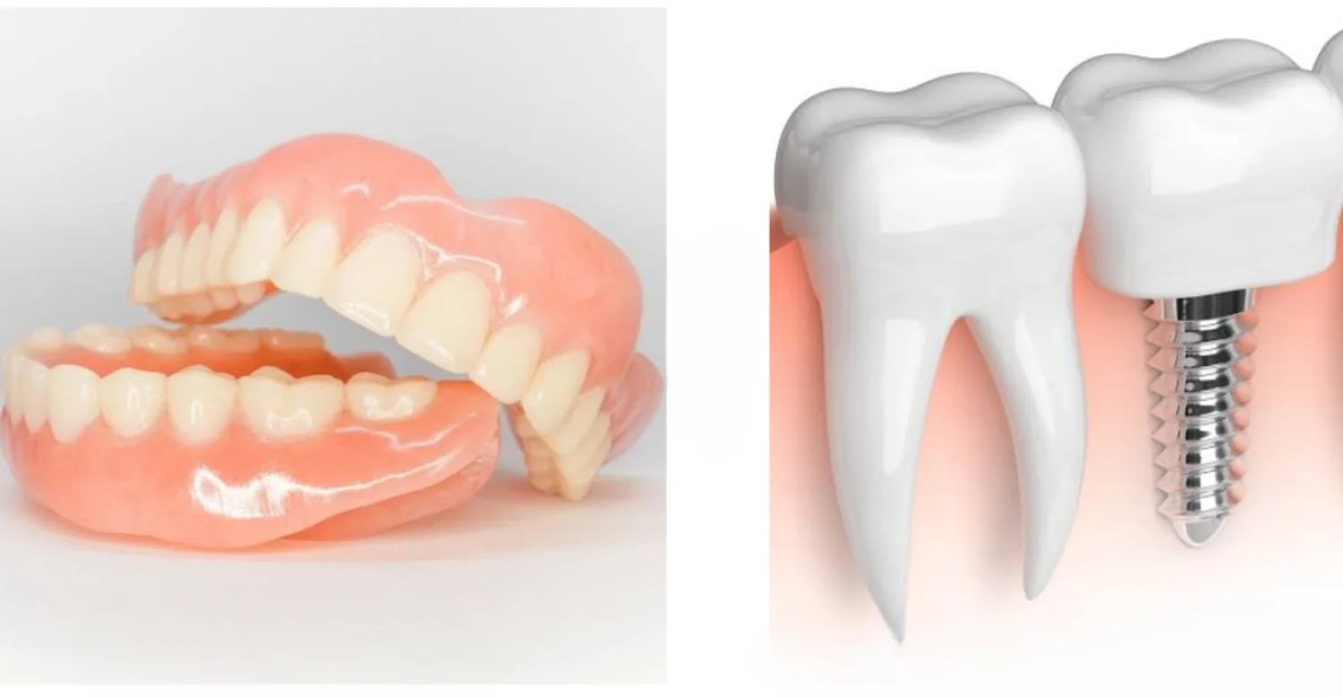 dental implants vs implant supported dentures 2